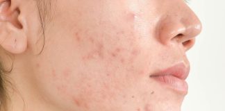 3 remedios caseros para combatir el acné -Miami news 24