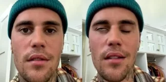 Justin Bieber parálisis facial - miaminews24