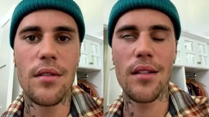 Justin Bieber parálisis facial - miaminews24