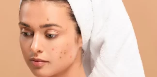 Granos frecuente acné rostro- miaminews24