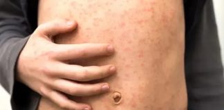 Florida entre los tres estados con más contagios de sarampión en EE. UU.